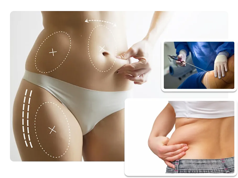 Before and after liposuction body contouring result