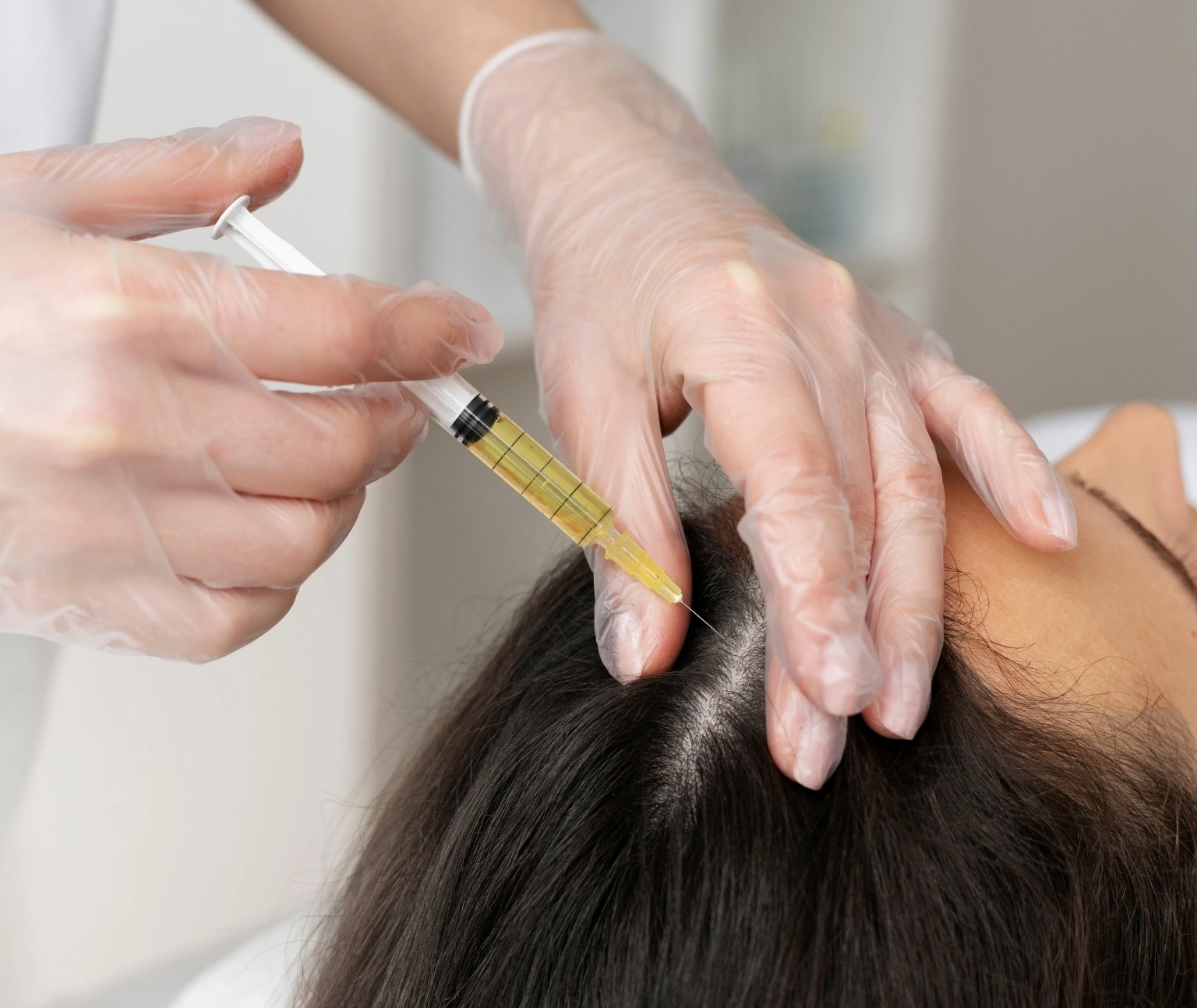 Doctor administering stem cell hair therapy to the scalp