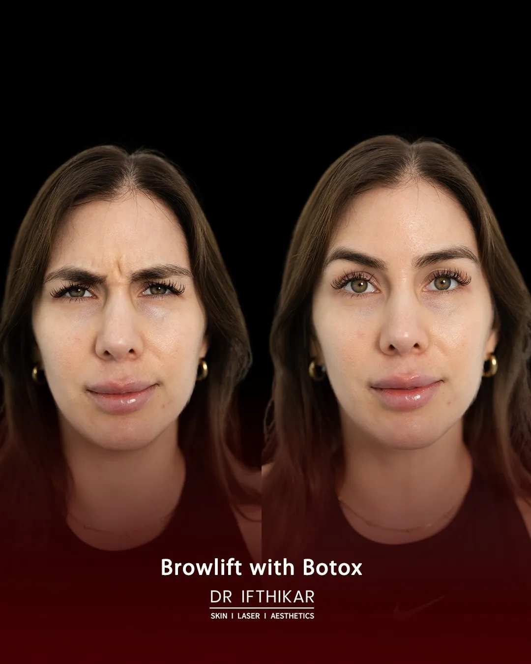 Botox brow lift before and after result