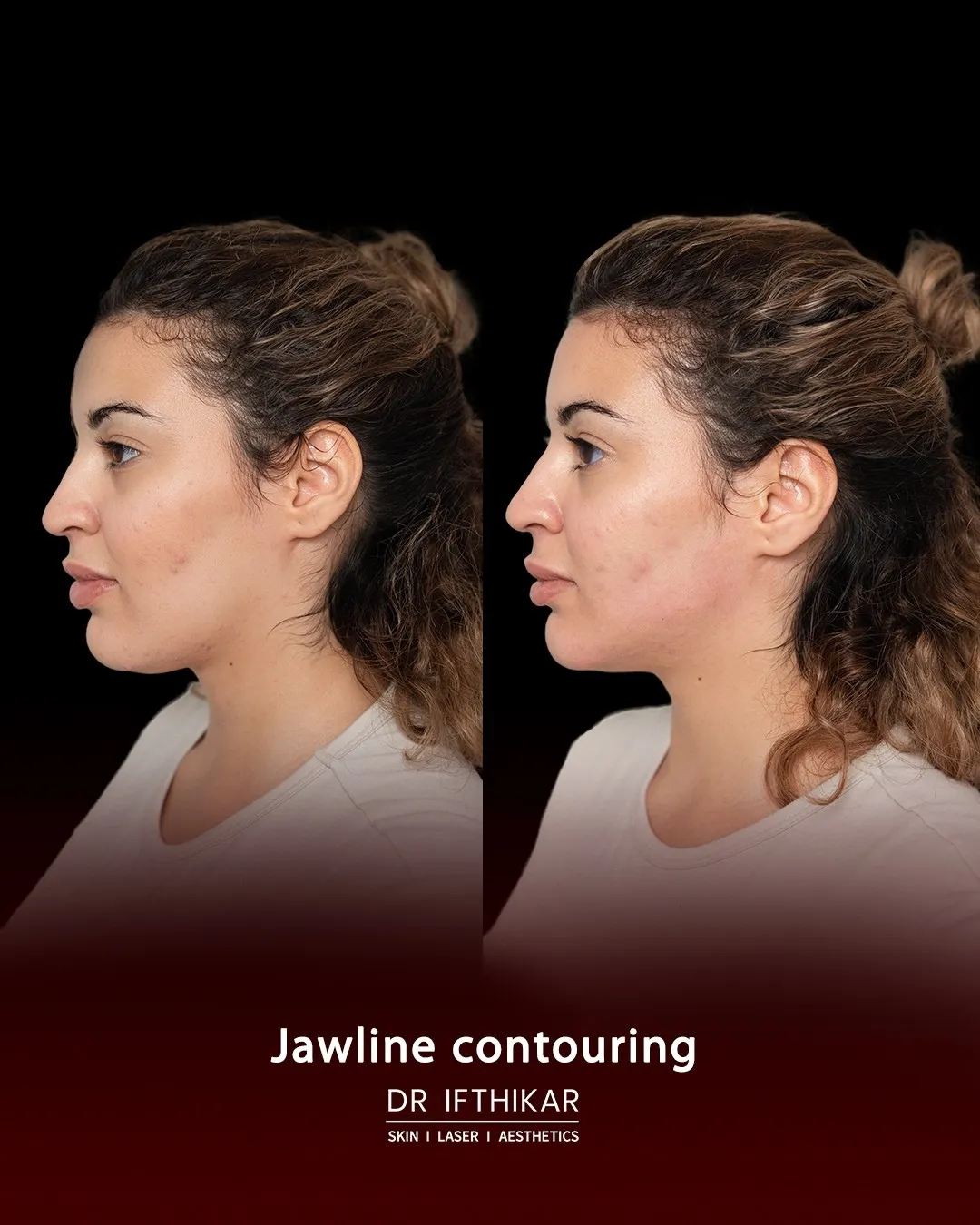 Jawline contouring before and after result