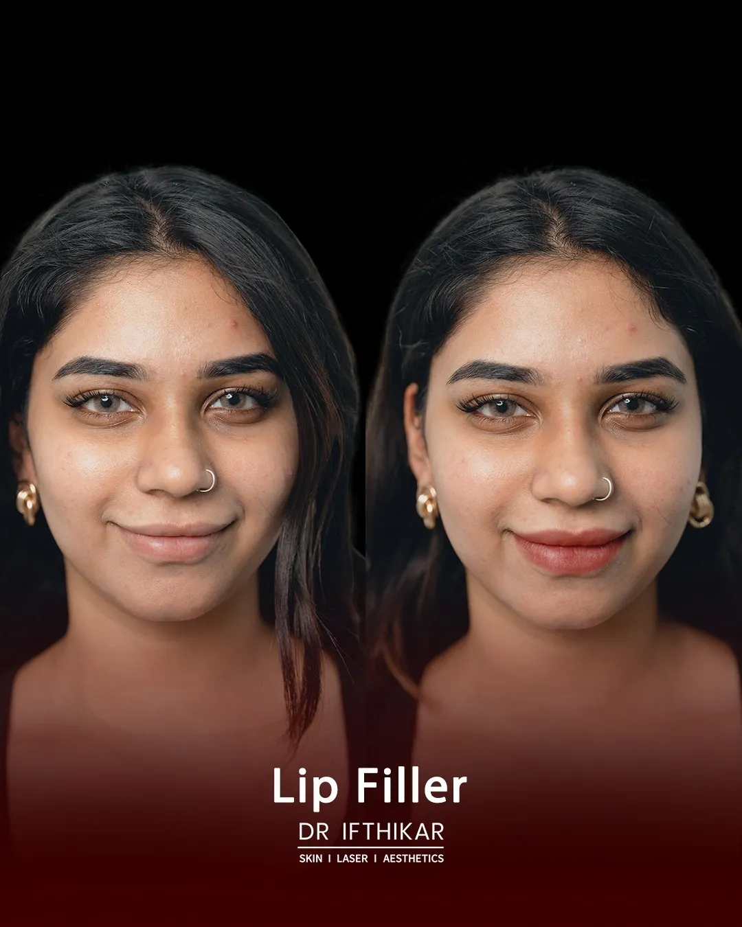 Lip filler before and after result