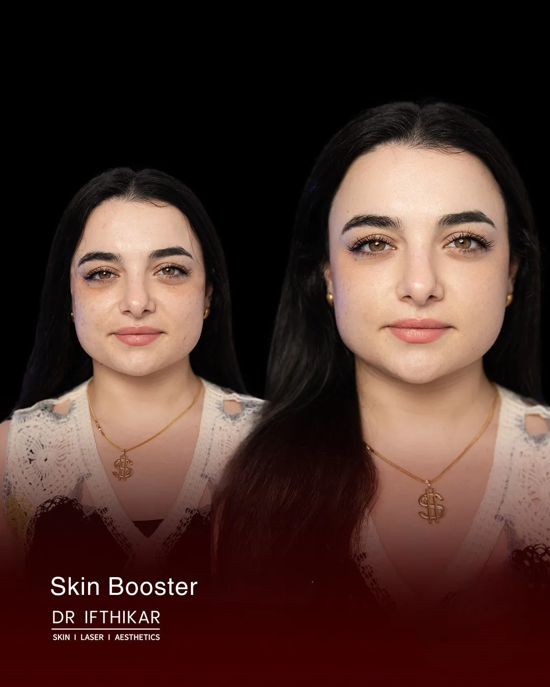 Skin booster before and after result