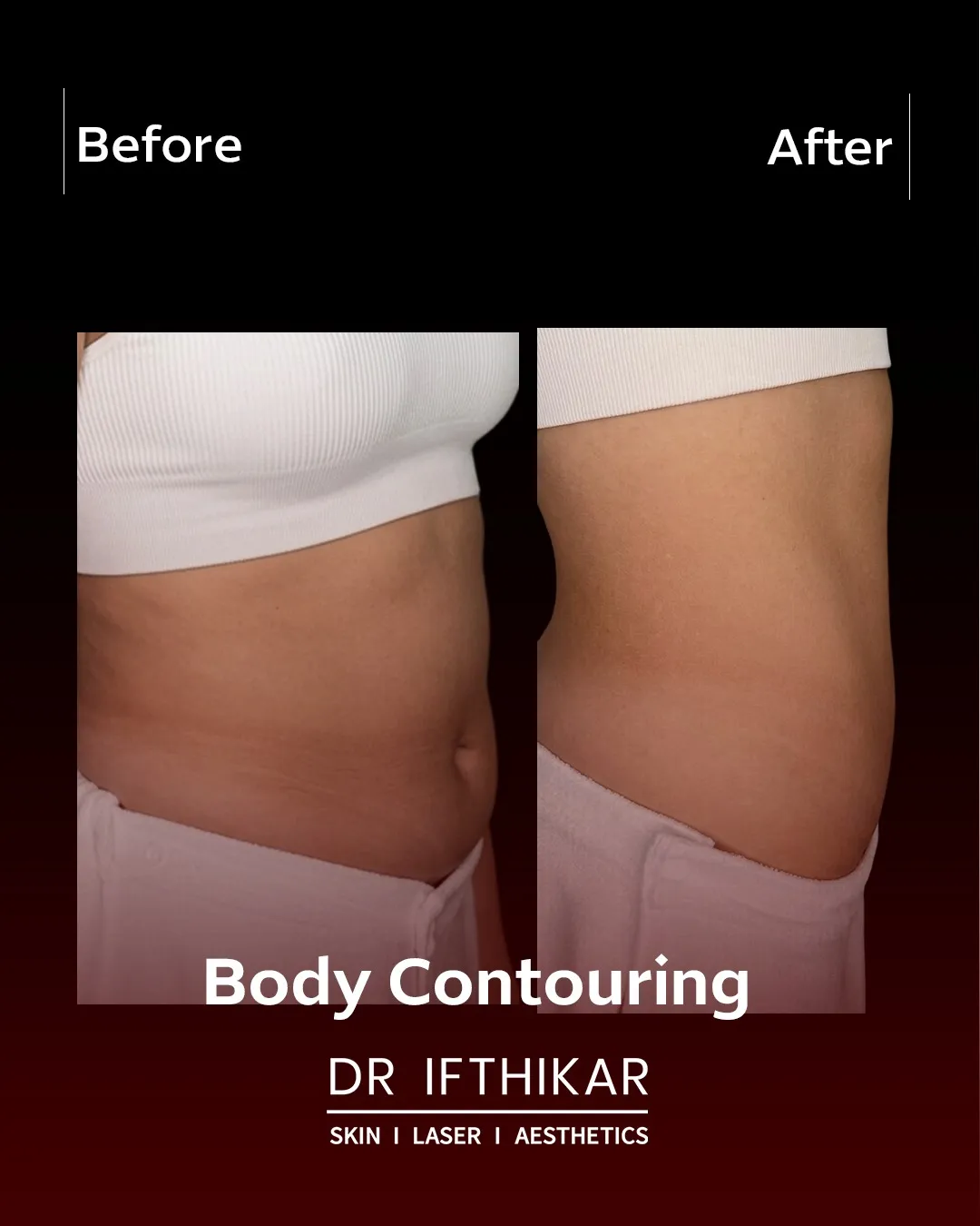 Before and after body contouring result