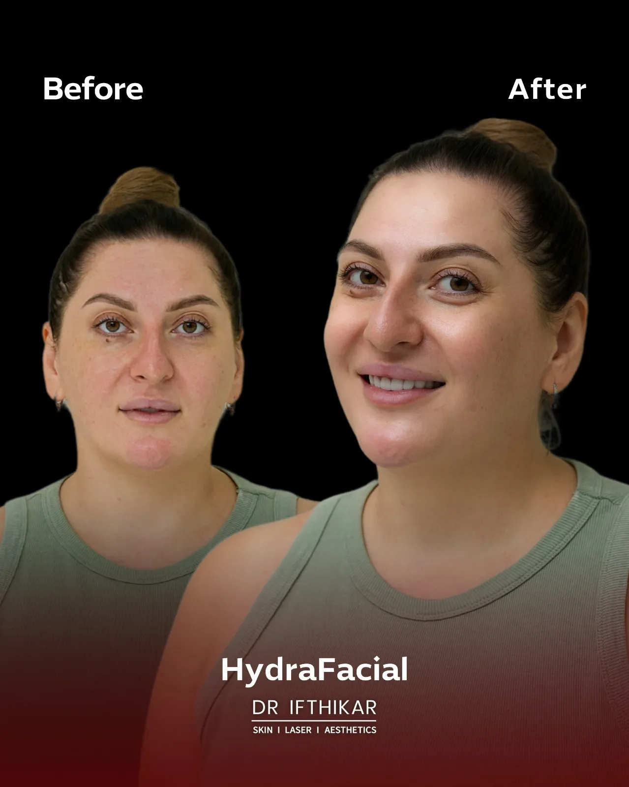 HydraFacial skin treatment at Dr. Ifthikar Medical Center